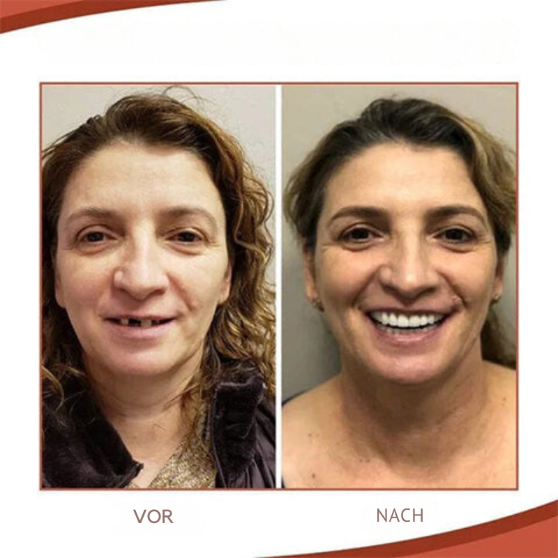 Davy | Biocompatible Silicone Prosthesis Set for Pain-Free Fit and Natural Smile